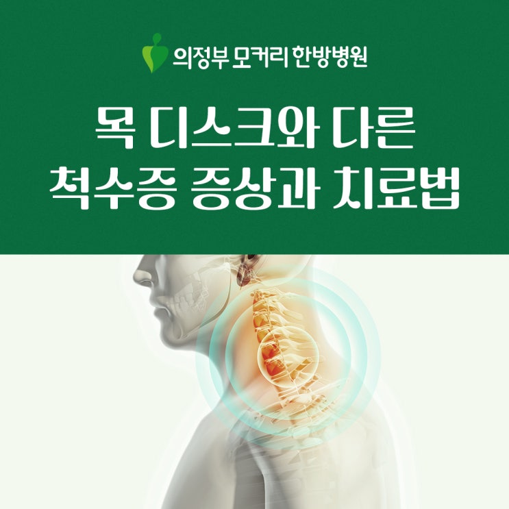  목 디스크보다 위험한 척수증, 증상과 치료법