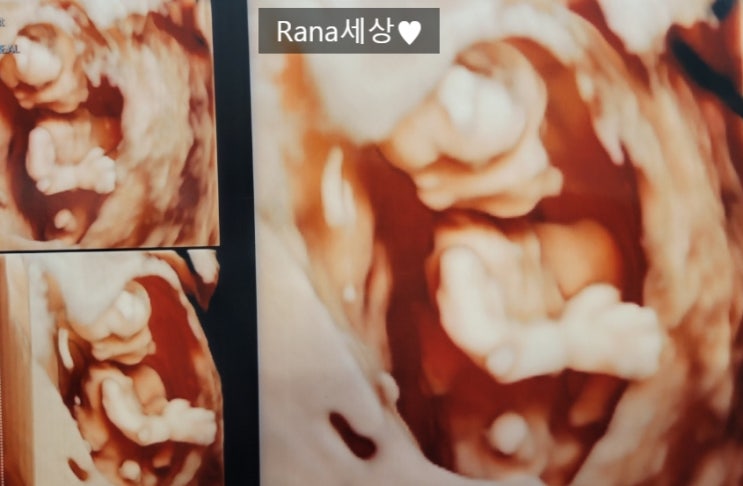  [임신일기] 12주차 1차 기형아검사 받았어요!(비용, 시간, 꿀팁)