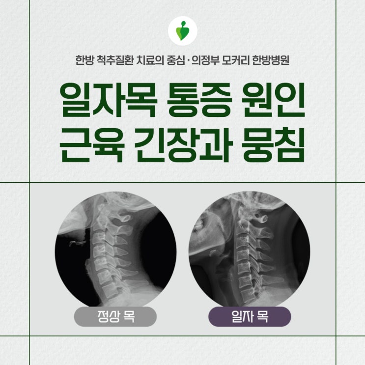  일자목 통증의 진짜 원인은 근육 긴장과 뭉침