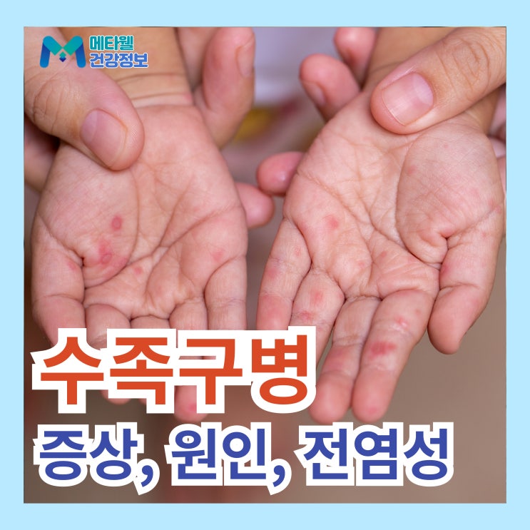  여름철 전염성 질환 수족구병 원인, 증상, 전염경로, 예방 및 치료법