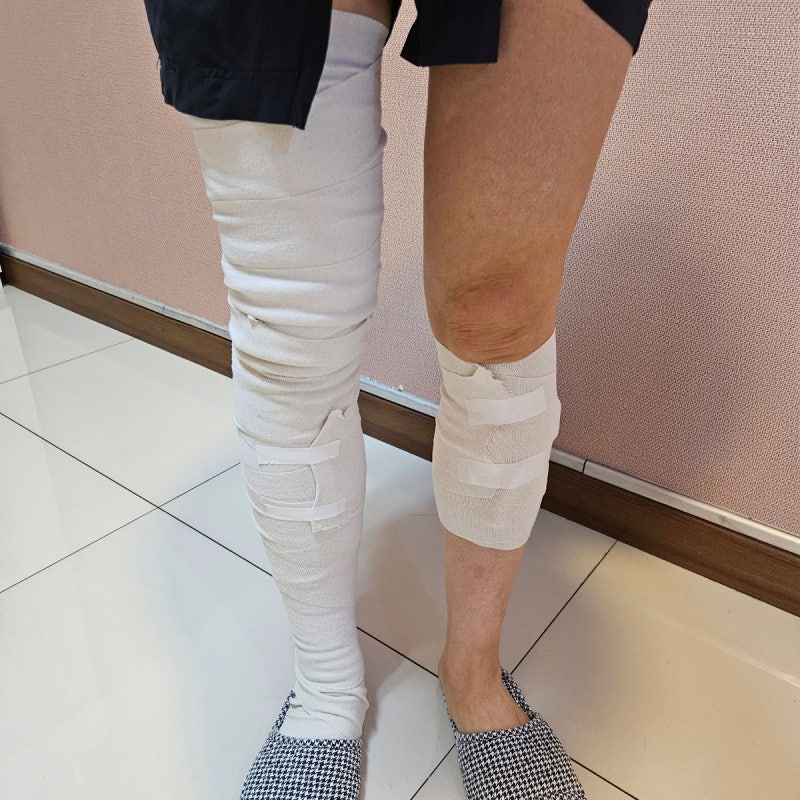 하지정맥류 수술 광주서울하정외과의원 하지정맥류 실비