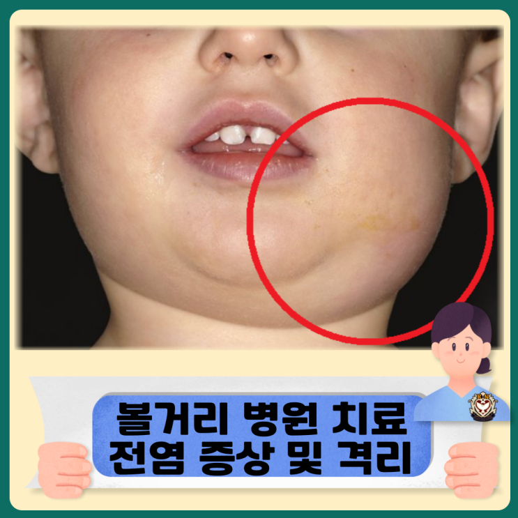  볼거리 병원 치료 해야하나 전염 증상 및 격리