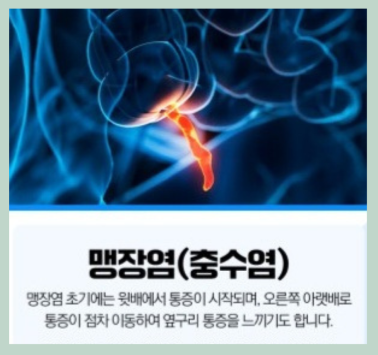  맹장염으로 알려진 충수염이란?