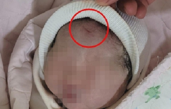 “제왕절개로 딸 낳았는데 이마에 ‘칼자국’”…부모 분통 “제왕절개로 딸 낳았는데 이마에 ‘칼자국’”…부모 분통