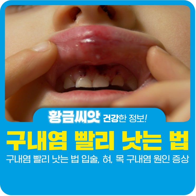  구내염 빨리 낫는 법 입술, 혀, 목 구내염 원인 증상