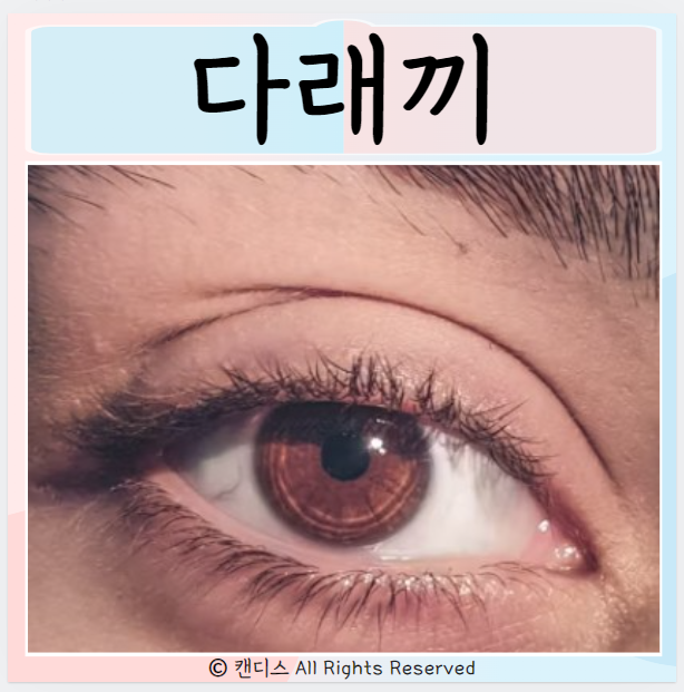  눈다래끼 종류 전염 원인 치료 증상