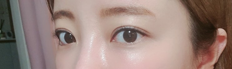  압구정피부과 눈밑울트라콜 한달후기 (멍,붓기)