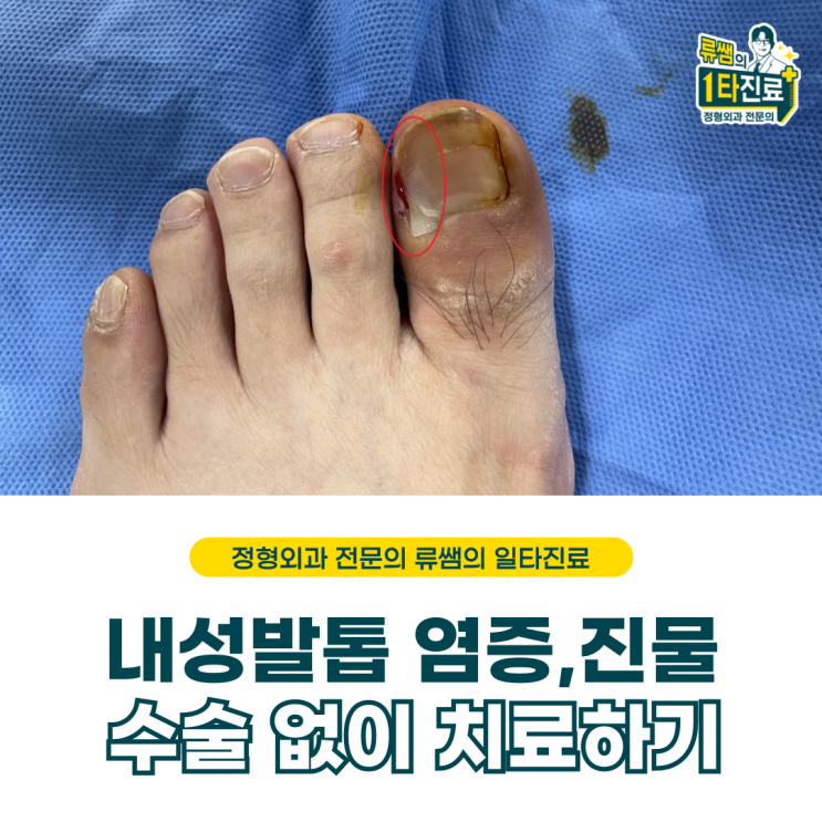  엄지발가락 염증/내성발톱 진물/치료/내성발톱 재발(의사작성)