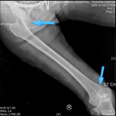 PELVIS AP, OBL,INLET,OUTLET,HIP JOINT 골반일반 촬영법 소개 : 네이버 블로그
