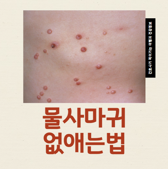 물사마귀 없애는법 집에서 관리하는 방법과 증상, 전염성
