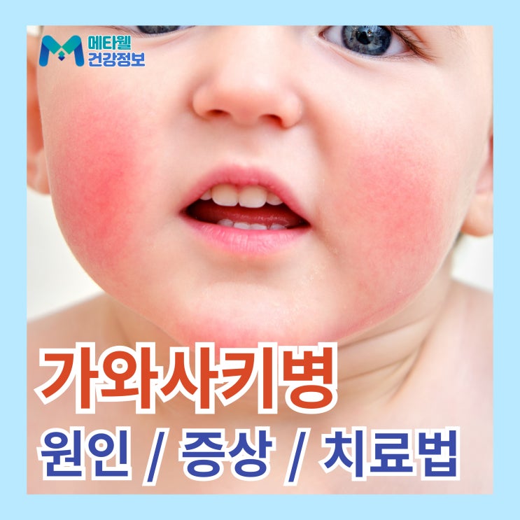  소아 심장병 주의! 고열이 지속되는 가와사키병 전염 딸기혀 원인 치료법