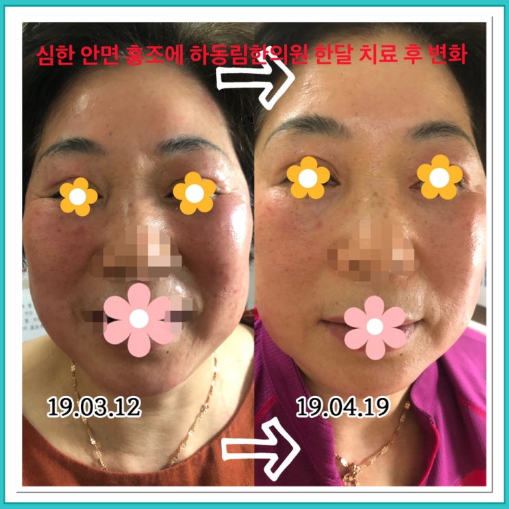  안면 홍조와 갱년기 증상, 불면증 한약, 침치료 1달만에 개선 사례