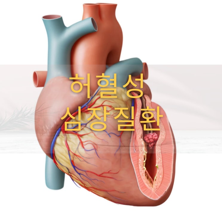  허혈성심장질환 보험 불안정협심증 I20, 협착률과 의료자문!?