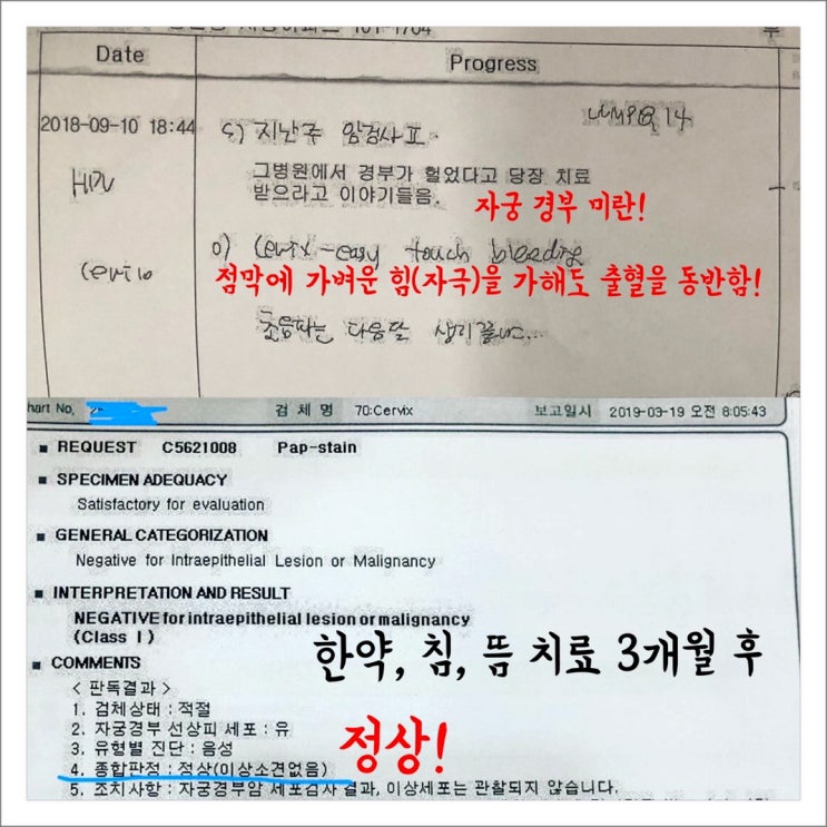  자궁경부염, 만성자궁 염증-한약, 침 치료 3개월 후 완치, 근종 크기 유지 후기