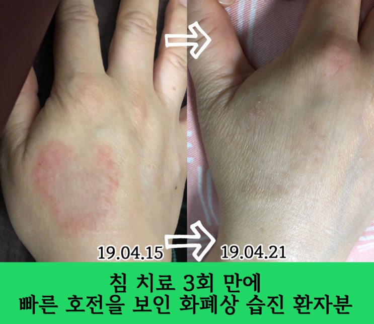  손 습진 3개월간 한의원 침치료로 호전된 사례