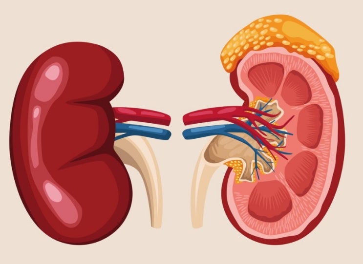 신장 결석 증상, 신장낭종 콩팥 물혹 원인은?