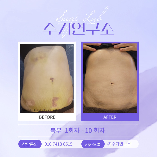  지방흡입 바이오본드 현상 완벽 가이드