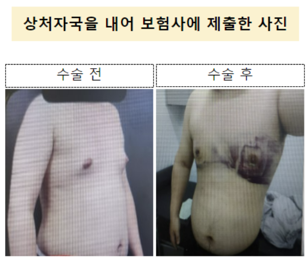 보험금 타내려 칼로 가슴에 수술 흔적까지 만든 MZ 조폭들 보험금 타내려 칼로 가슴에 수술 흔적까지 만든 MZ 조폭들