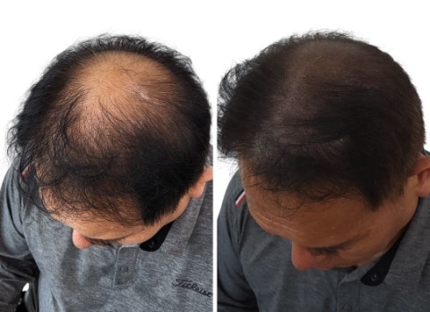  인천두피SMP 잘하는 곳 3회차 아빠후기