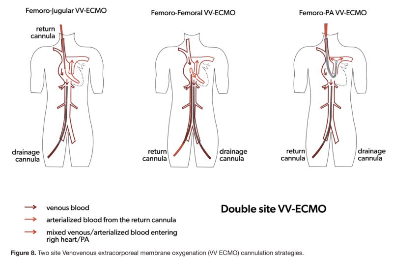 ECMO 간호 기본 파악하기. 에크모 원리, 적응증, 유형 VV ECMO /VA ECMO /Central ECMO/Hybrid ...