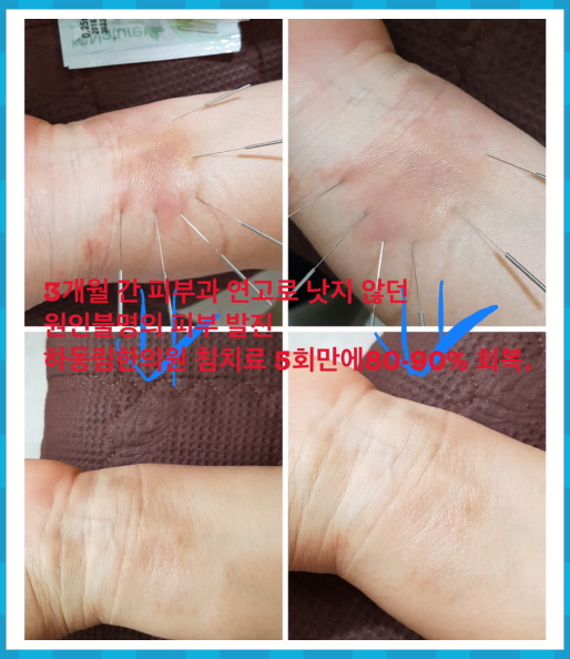  3개월간 연고 치료로 낫지 않던 피부 발진 가려움, 2주만에 80%호전