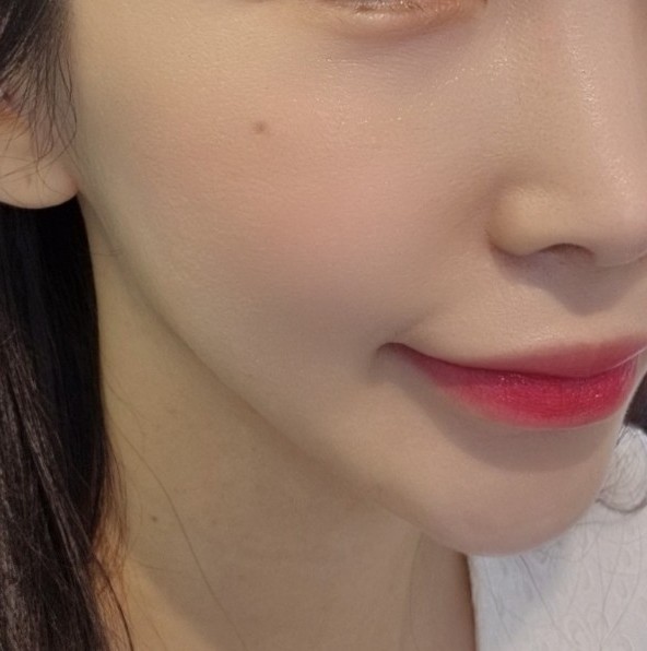  청담 스킨부스터 효과 확실한 엑소좀 나도 드디어 받아봄