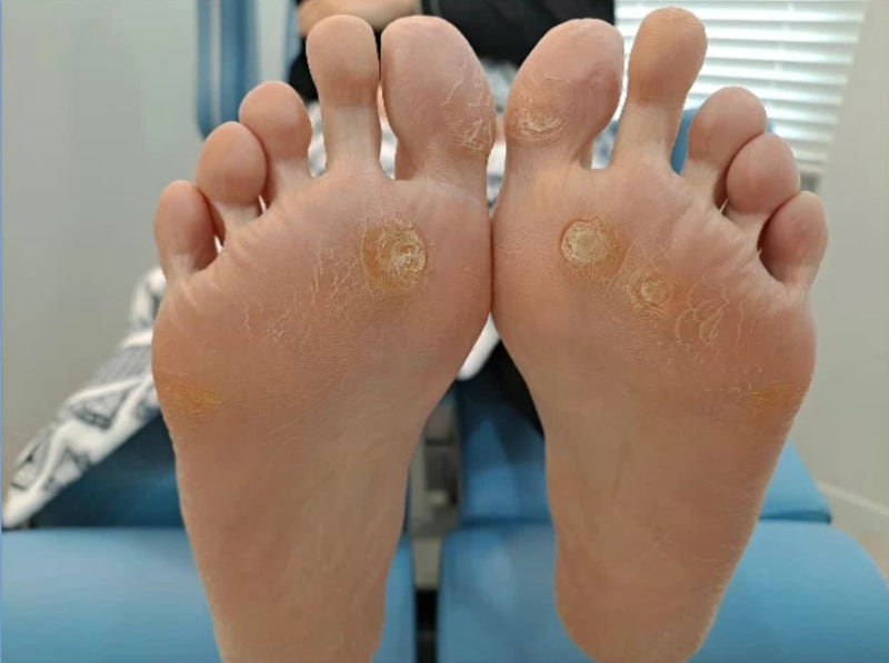 (청주)발에 생긴 티눈!! 어디로 가시나요??