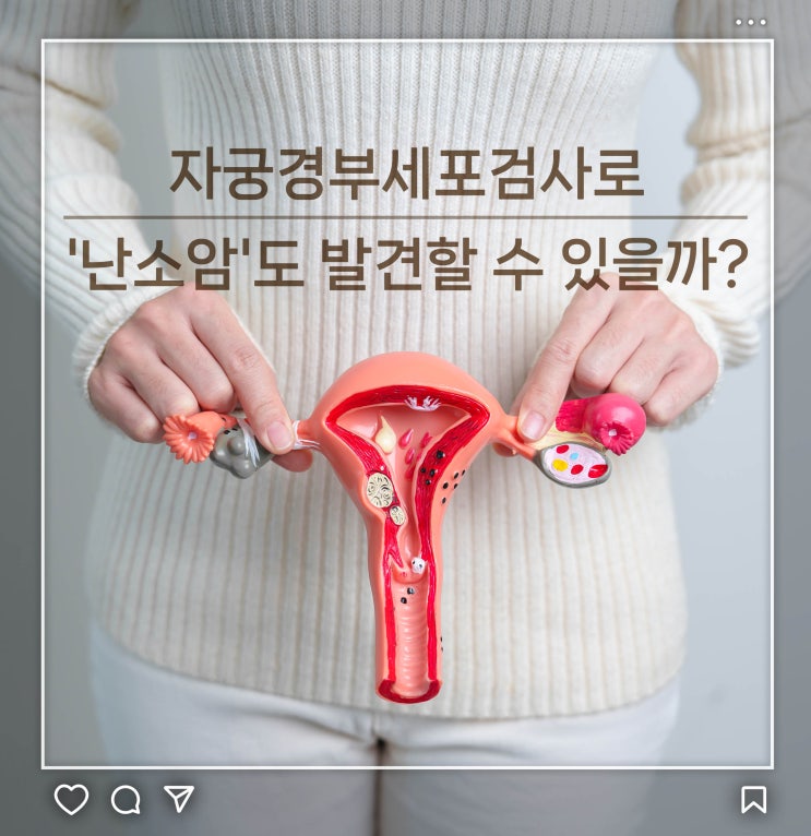  자궁경부세포검사로 '난소암'도 발견할 수 있을까?