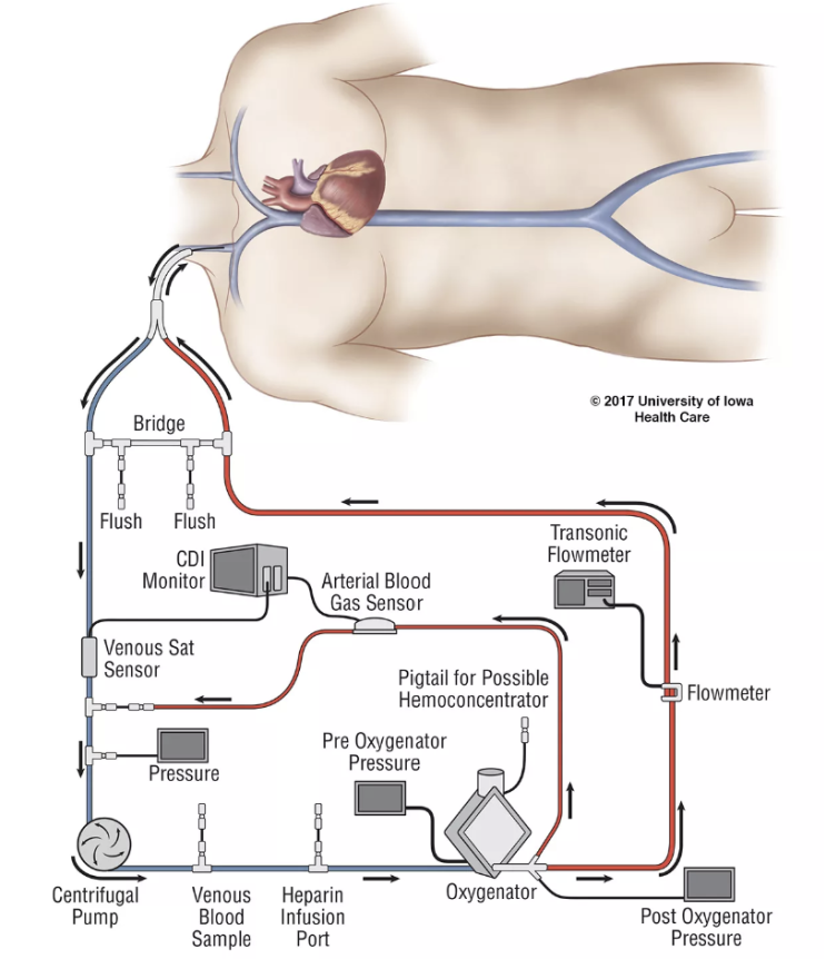  ECMO의 기본 파악하기. 에크모 원리, 적응증, 유형 VV ECMO /VA ECMO /Central ECMO/Hybrid ECMO/ ELSO Guideline 기반 정리