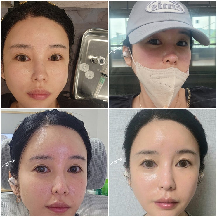 서면피부과 셀엑소좀 내돈내산 후기 & 다운타임 후 관리 팁! 서면피부과 셀엑소좀 내돈내산 후기 & 다운타임 후 관리 팁!