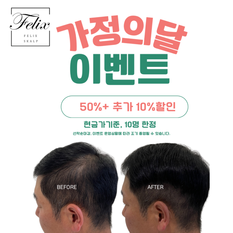  자연스럽게 탈모커버 잘하는곳!구래동두피문신 필릭스스칼프로!