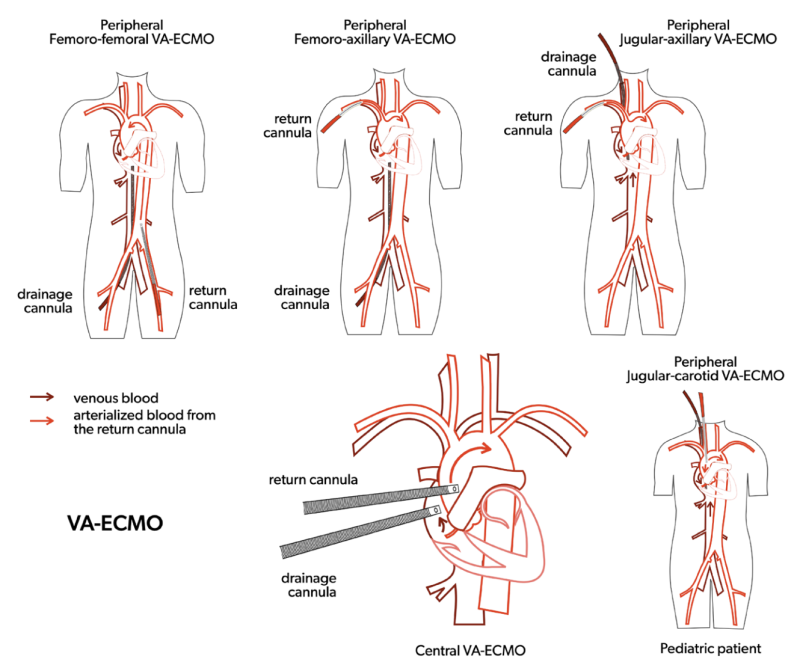 ECMO 간호 기본 파악하기. 에크모 원리, 적응증, 유형 VV ECMO /VA ECMO /Central ECMO/Hybrid ...