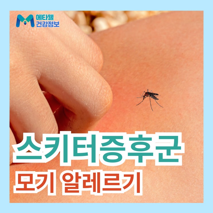 나도 혹시 모기알러지? 스키터증후군 원인 증상 진단방법 모기 알레르기 치료법