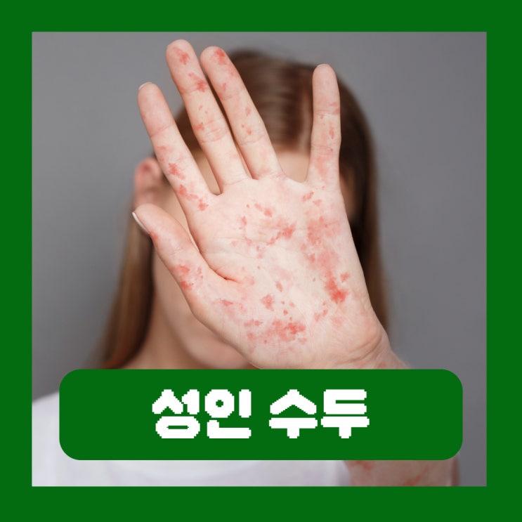  성인 수두 초기증상 전염 원인 격리 치료 예방접종 필수 병원