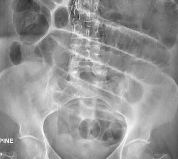 의학용어 ileus (장 폐색) Intestinal obstruction (장 폐쇄) 원인, 치료 등을 알아보자! : 네이버 블로그