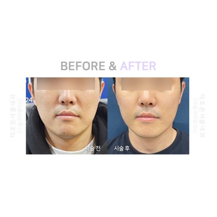  안산 남자볼뉴머 리프팅 피부과 효과가 이렇습니다.