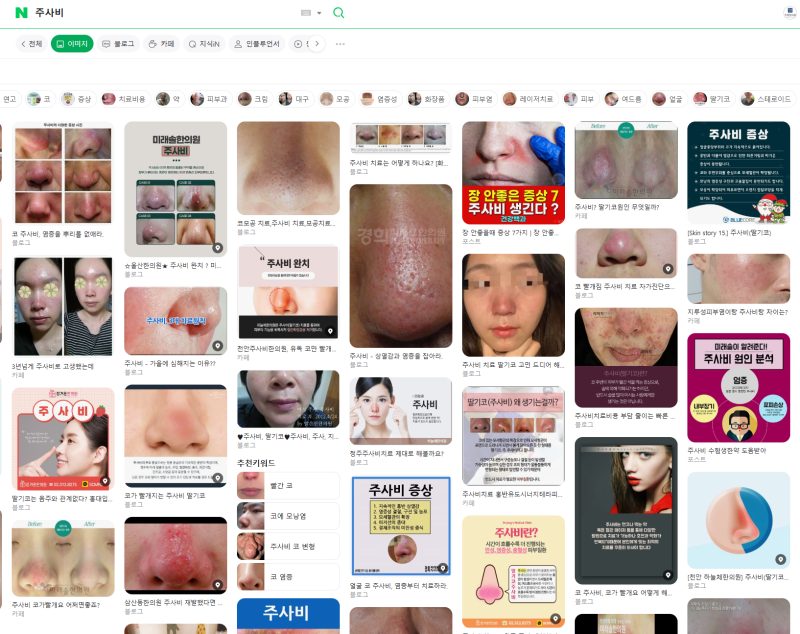 이목한의원 주사비 딸기코 한의원치료