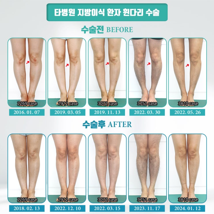 오다리 필러 교정의 결과는 어떨까요? 지방이식을 통한 휜다리 교정은 가능한 것일까? | 종아리성형