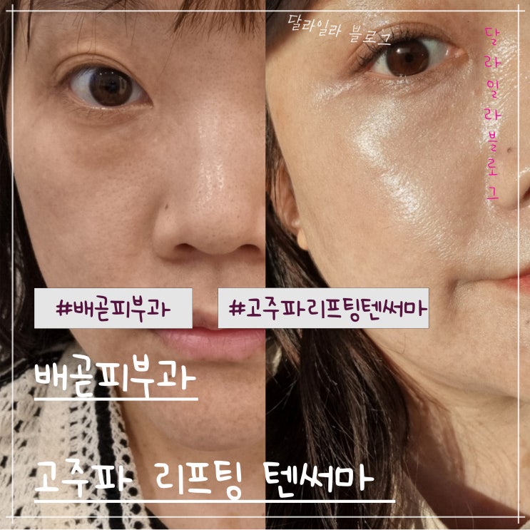  배곧피부과 자극없는 고주파 리프팅 텐써마 후기