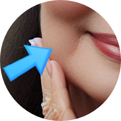  울쎄라 꼭 얼굴 전체에 해야 할까 (내가 원하는 건 볼 꺼짐 없이 턱 라인만 리프팅) - 삼성동 피부과전문의 닥터림
