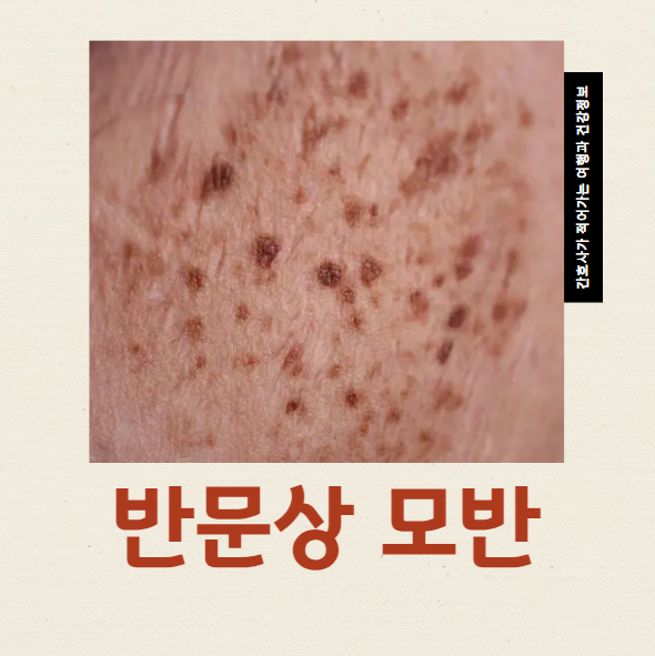  반문상모반 모양특징과 레이저 치료 방법