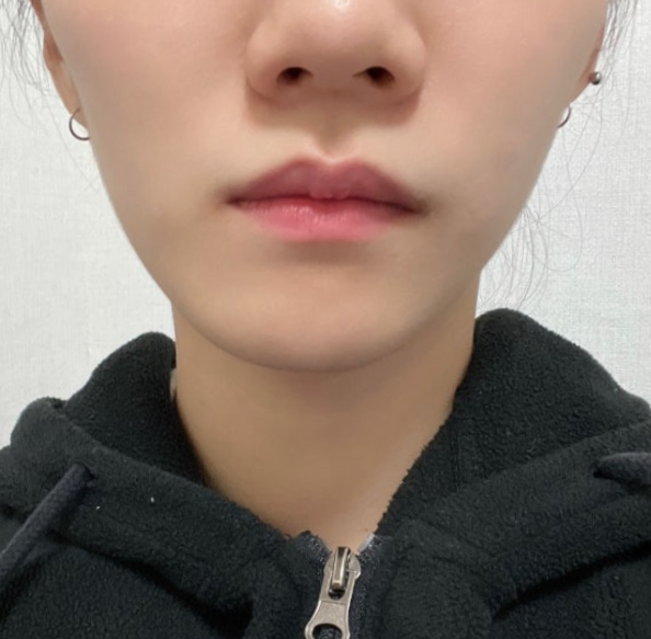  턱 비대칭 교정, 안면비대칭 수술 없이 오징어 탈출 후기!