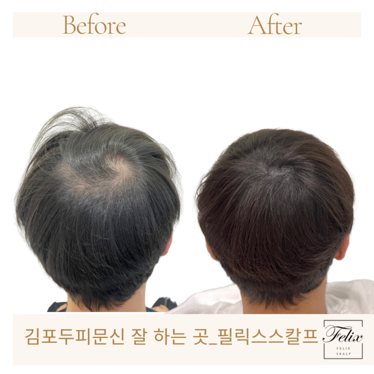  구래동두피문신으로 더 예뻐지세요!