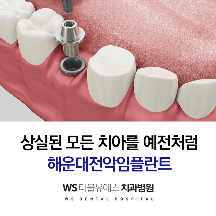  부산전악임플란트 확인하세요