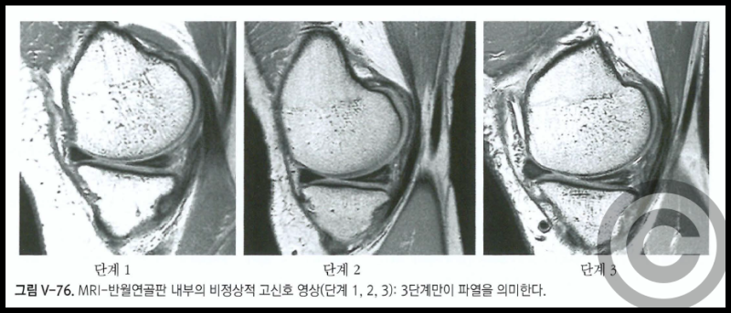반월 연골판 파열 종류, 증상, 진단, 치료는? : 네이버 블로그