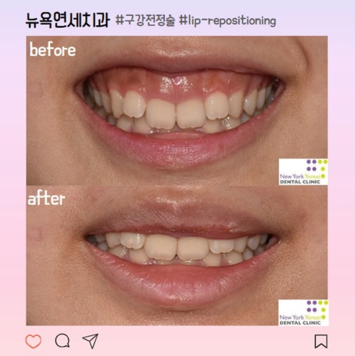  연예인 잇몸성형 후기, 원인과 해결 방법