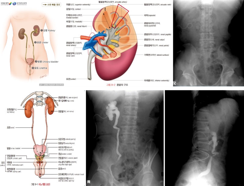 IVP 또는 RGP가 불가능할때 시행하는 선행성 신우조영술(AGP, Antegrade Pyelography, 하행성 콩팥깔대기 ...