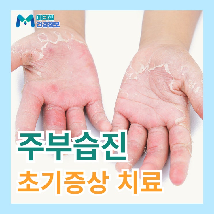  주부습진 갈라짐 손가락 가려움 물집 생기는 원인 초기증상 알아보기