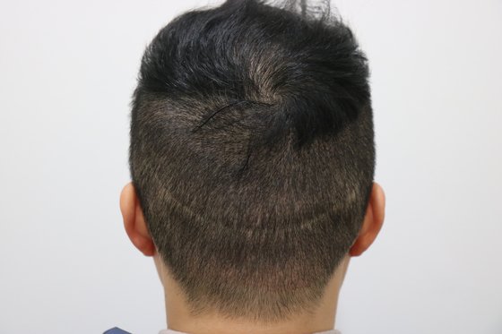  터키는 왜 비절개 모발이식만 할까?