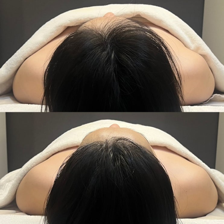 [창원원피부관리] v라인테라피 , 대방동웨딩관리 “ <b>카리나</b>... 